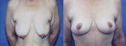 Before and after a breast augmentation