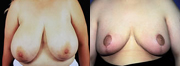 Before and after breast asymmetry photos - Beverly Hills plastic surgeon Dr. Lent