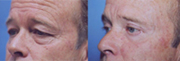 Additional Laser eyelid surgery photos