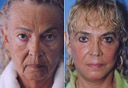 Before and after a Beverly Hills facelift