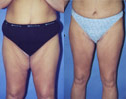 Before and After Thigh Lift Photos