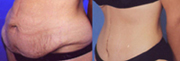 The before and after Beverly Hills tummy tuck procedure